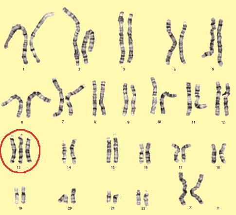 Τρισωμία 13 και τρισωμία 18 o Η τρισωμία 13 είναι γνωστή και ως σύνδρομο Patau. o Η τρισωμία 18 είναι γνωστή και ως σύνδρομο Edwards.