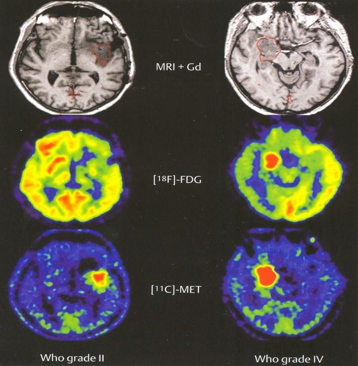 Όγκοι Εγκεφάλου διαγνωστική προσέγγιση PET Μεταβολική εκτίμηση της επιθετικότητας του όγκου, διαφορική διάγνωση μεταξύ