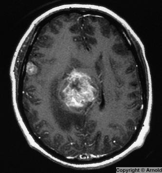 Μεταστατικοί όγκοι εγκεφάλου 50% των ενδοκράνιων όγκων 20-40% των ασθενών με καρκίνο εμφανίζουν εγκεφαλικές μεταστάσεις Εντόπιση: 80% εγκεφαλικά ημισφαίρια, 15% παρεγκεφαλίδα, 5%