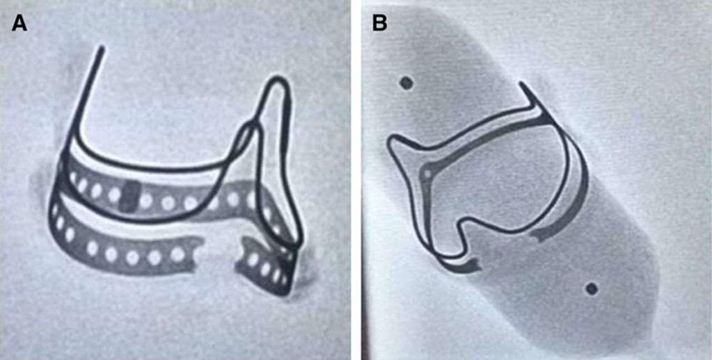 Ex vivo fluoroscopic images of fractured Magna (A) and Magna Ease (B) bioprosthetic valves. Adnan K.