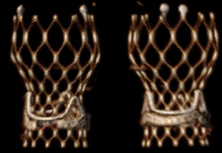 Computed tomography (CT) reconstruction of a patient who underwent valve-in-valve (VIV) transcatheter aortic valve replacement (TAVR) with a 23-mm CoreValve Evolut R in a 19-mm Edwards