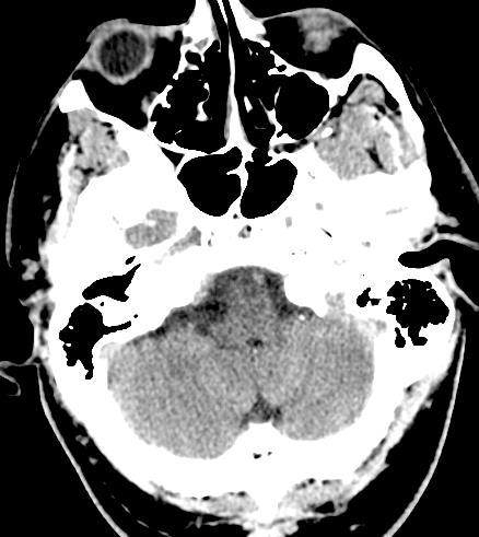 CT scan