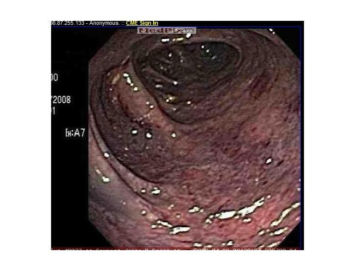 Διάγνωση: κολονοσκόπηση Δεν υπάρχει άμεση συσχέτισης της ενδοσκοπικής εικόνας με την κλινική εικόνα και την έκβαση της ισχαιμίας Αρχική φάση: υποεπιθηλιακές