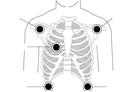 Na monitorovanie pacientovho elektrokardiogramu sa používa štandardná konfigurácia s 3 zvodmi alebo 5 zvodmi.