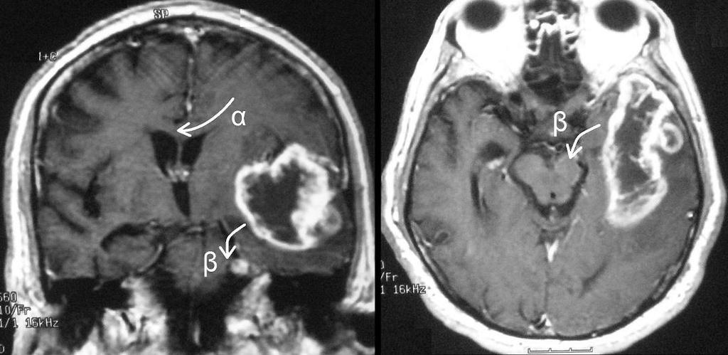 10 Σχήμα 3. MRI ασθενούς με ταχέως επιδεινούμενο επίπεδο συνείδησης (ακολουθία Τ1 με έγχυση παραμαγνητικής ουσίας).