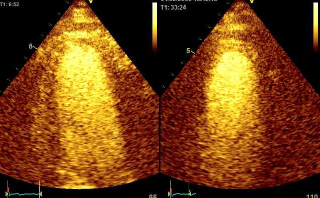 Dobutamine stress test