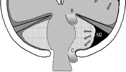 Infratentorial herniation(υποσκηνιδιακός) Α: