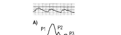 ICP waveform, a