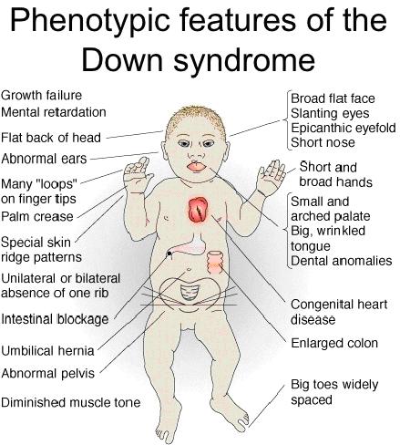 Εικόνα 7. Φαινοτυπικά χαρακτηριστικά συνδρόμου Down Adapted from: http://www.slideshare.net/medik.