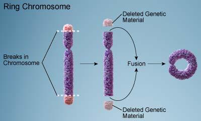 Δακτυλιοειδή χρωμοσώματα Όταν υπάρχουν ελλείμματα και στα δύο άκρα ενός χρωμοσώματος, τα άκρα αυτά μπορεί να ενωθούν μεταξύ τους και να σχηματίσουν ένα δακτυλιοειδές χρωμόσωμα (ring chromosome) 6