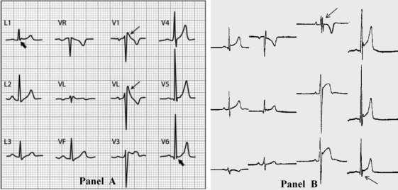 rsr' pattern in V 1, QRS duration of <120 ms and reciprocal S
