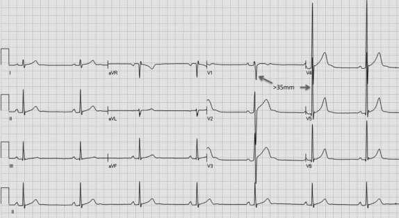 Abnormal ECG from a