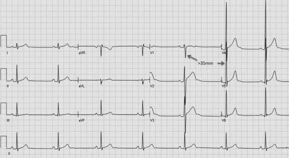 Abnormal ECG from a