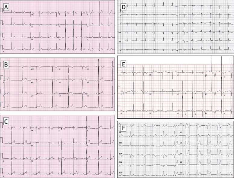 Normal and Abnormal Patterns of T-Wave Inversion 12-yrs juvenile pattern ARVC 17-yrs
