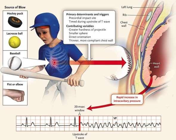 Commotio cordis