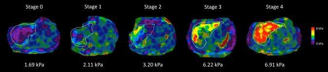 MRE και διάγνωση ίνωσης σε ασθενείς με NAFLD 117 ασθενείς με βιοψία ήπατος Καλή ευαισθησία για προχωρημένη ίνωση