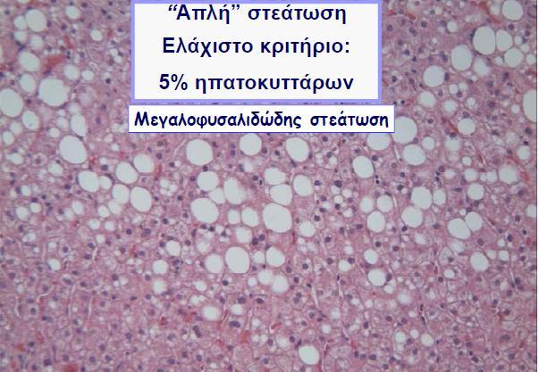 Ιστολογικά ευρήματα στη NAFLD NASH ballooning Grading : NAFLD
