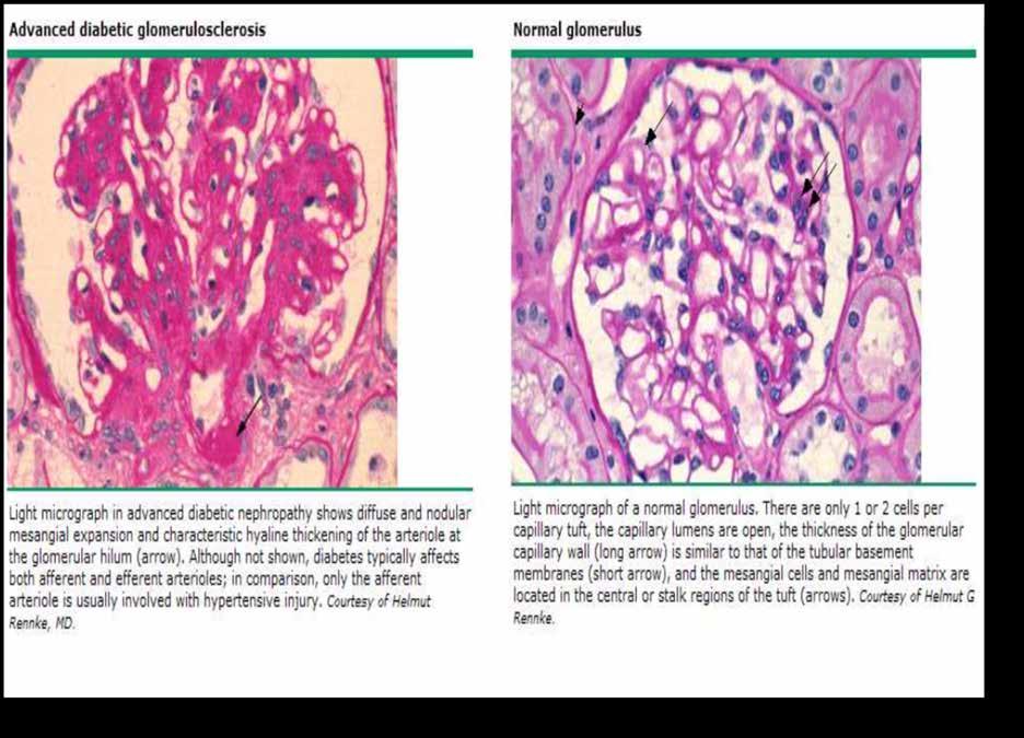 Wilson) lesions of global glomerular