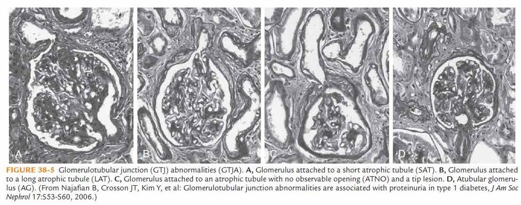 Renal biopsies from 5 normoalbuminuric pts, 5