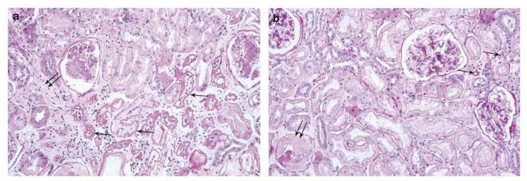 8 non-uremic type I DM patients at 5 and 10 years after PTA Τhe Volume advanced fraction of interstitial interstitial fibrosis collagen and cells per cortical Tissue