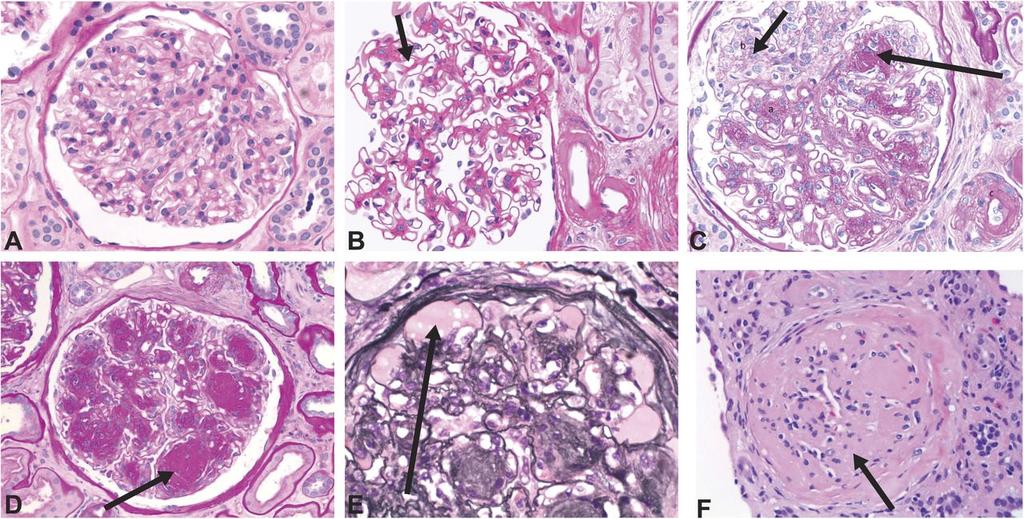 ΔΝΝ : Σπειραματικές βλάβες Normal glomerulus Diffuse mesangial expansion Prominent mesangial expansion / early nodularity Kimmelstiel Wilson nodules
