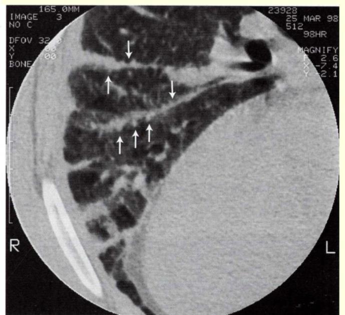 CT θώρακα Οζίδια 1-2mm, εικόνα