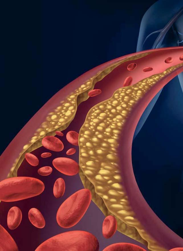 Čím cholesterol ubližuje? LDL cholesterol, správne teda skôr LDL častice, prinášajú cholesterol do ciev, kde sa môže ukladať, a vyvolávať tak ich kôrnatenie, známe ako ateroskleróza.
