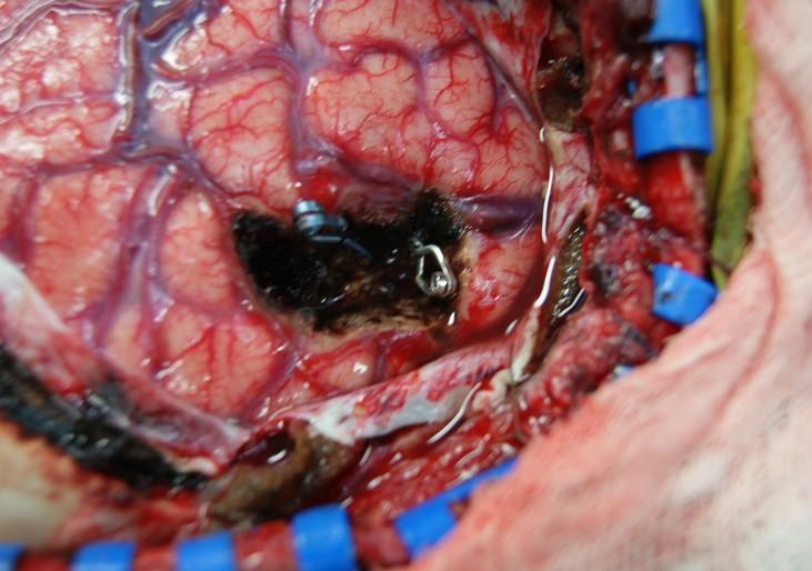 Θεραπευτική προσέγγιση Η χειρουργική αφαίρεση ενός αυτόματου ενδοεγκεφαλικού αιματώματος δεν συνοδεύεται πάντα από βελτίωση της κλινικής εικόνας του ασθενους και καθορισμό της πρόγνωσης, καθώς η
