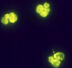 cryoglobulinemia Pauci-immune complex diseases (Type 3) - ANCA related (Microscopic polyarteritis,