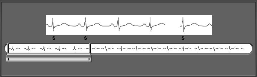 Tabuľka 3: Značky S-EKG na obrazovkách Monitora programátora a Vytlačených hlásení.