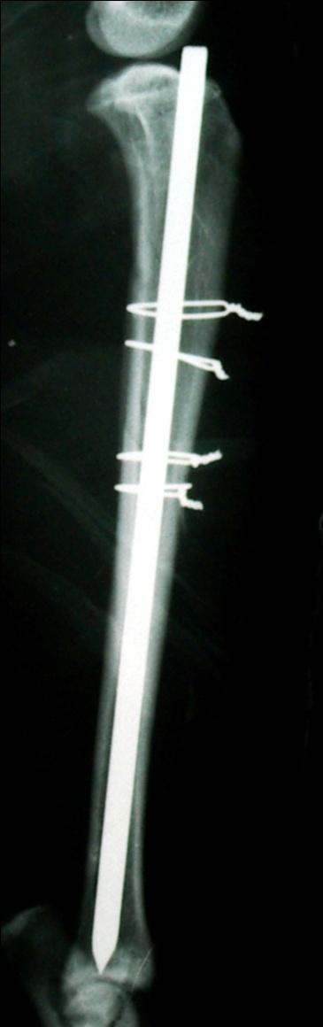 A B C D (A) Sagitalni rendgenogram stabilizacije spiralnog loma