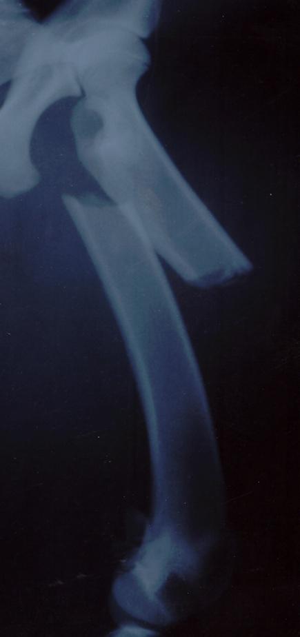 Osteosinteza dijafiznog loma VANJSKA I