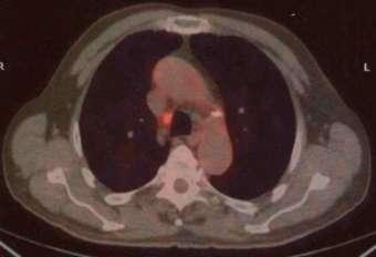 staging techniques for lung
