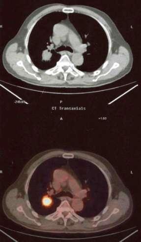PET/CT Η PET βοηθάει στην