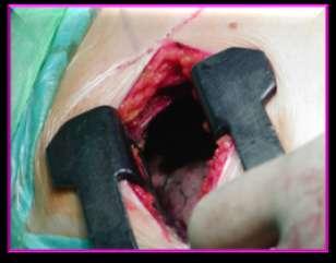 Rolle A, Pereszlenyi A, Koch R, Richard M, Baier B. Is surgery for multiple lung metastases reasonable?