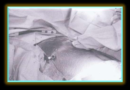 Θωρακοσκοπικη προσέγγιση Detterbeck FC, Egan TM :Thoracoscopy using a