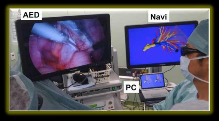 Binocular stereo-navigation for three-dimensional thoracoscopic lung resection Kanzaki M, Isaka T, Kikkawa T, Sakamoto K, Yoshiya T,