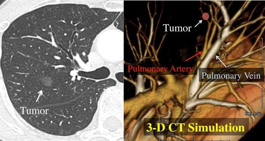 3-D CT Simulation όγκος