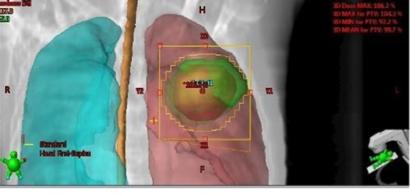 Το παράδειγμα της ακτινοθεραπείας (3D-CRT) Ο Ακτινοφυσικός επιλέγει στο TPS τον αριθμό των δεσμών που πρέπει να χρησιμοποιηθούν και την γωνία