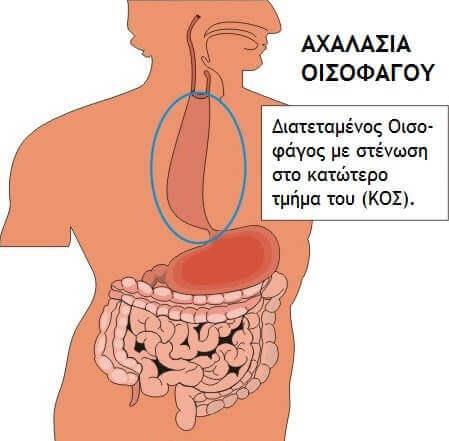 Εικόνα: Αχαλασία οισοφάγου https://www.endoscopicsurgery.gr/wpcontent/uploads/2016/03/achalasia_oisofagou.