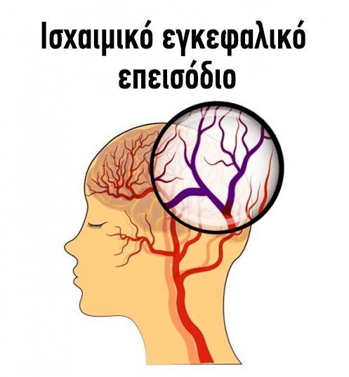 αιφνίδια εγκατάσταση εστιακής νευρολογικής βλάβης χωρίς να αναφέρεται προηγούμενο παροδικό ΑΕΕ µε παρόμοιες κλινικές εκδηλώσεις.