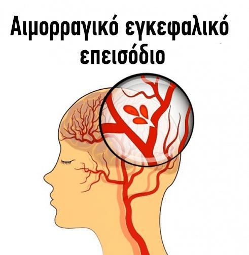 Εικόνα 8. Ρήξη των αιμοφόρων αγγείων και αιμορραγία μέσα η γύρω από τον εγκεφαλικό ιστό 3.
