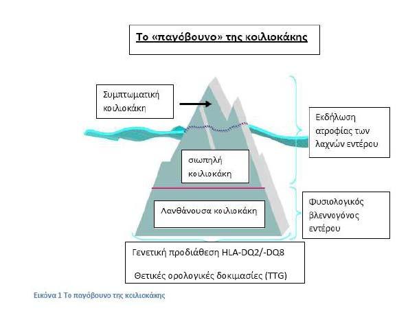 και με διάρροια. Η αντίληψη αυτή σήμερα έχει πλέον ανατραπεί. Η κοιλιοκάκη είναι κοινή νόσος σε ολόκληρο τον κόσμο. Τα συμπτώματα ωστόσο, μπορεί να είναι ελάχιστα ή να παρουσιάζονται ως άτυπα.
