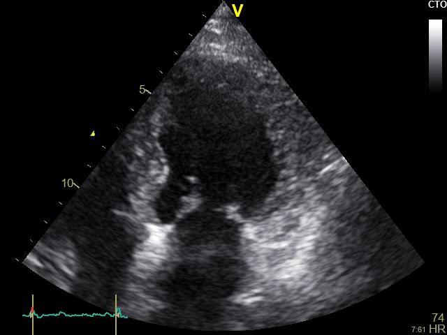 Case Presentation Imaging methods Cardiac Doppler U/S: 1. concentric LV wall thickening, with sparkling myocardial texture, & grade 2 dia dysfunction with increased filling P findings 2.