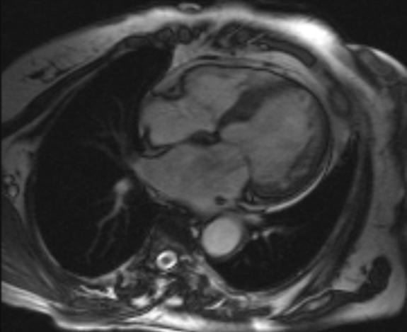 Case Presentation Cardiac MRI 1. mildly dilated LV, with mildly increased wall thickness & mildly influenced sys performance 2. LA dilatation 3.