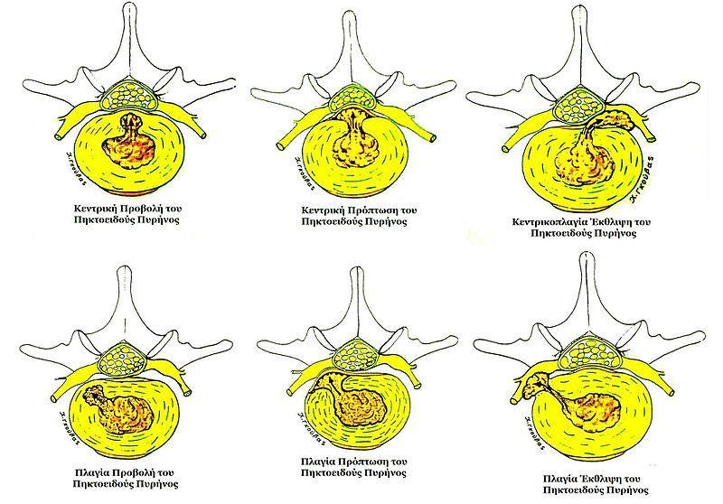 Εικόνα 13: Είδη δισκοκήλης (Πηγή: Λαμπίρης, 2007) Σχετικά με την τυπική κλινική εικόνα της οξείας δισκοκήλης αρχίζει με μέτριο, δυνατό ή ανυπόφορο πόνο στην οσφύ.