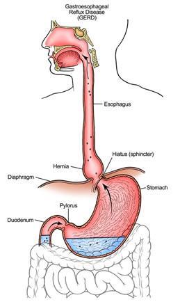 ΧΡΟΝΙΟΣ ΒΗΧΑΣ- Γαστροοισοφαγική παλινδρομητική νόσος (GERD) Τρίτο συχνότερο αίτιο