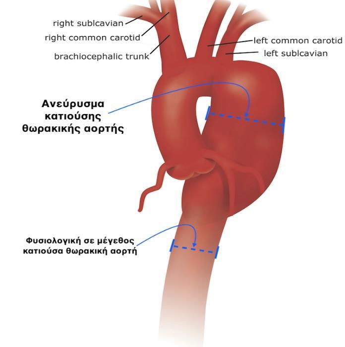 Εικόνα 1.11: Ανεύρυσμα θωρακικής αορτής [I-18] Συνήθως η αθηροσκλήρυνση εντοπίζεται στις στεφανιαίες αρτηρίες, με αποτέλεσμα ένα καρδιακό επεισόδιο.