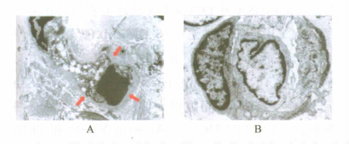 2 AGEs AGEs 5 3 15 000 Fig. 3 Transmission electron microscopic imaging of ultrastructure of skin microvessels in normal and diabetic rats 15 000 A B 2. 3 GSP MDA GSH Fig. 4 P < 0. 01 1 Tab.