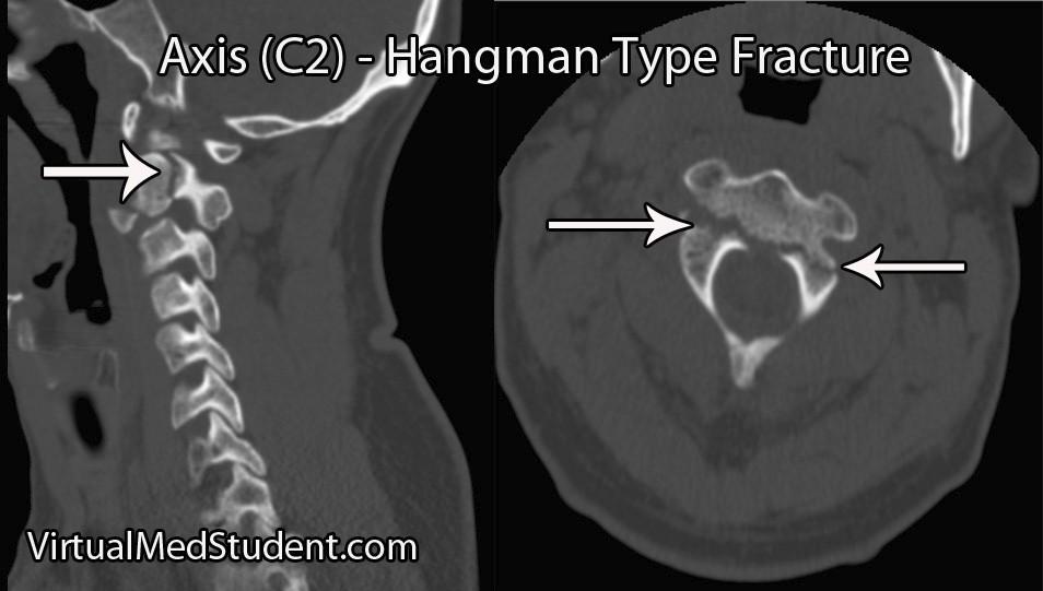 Κατάγματα τού ισθμού του Α2 σπονδύλου Η τραυματική σπονδυλολίσθηση Α2 ή Hangman's fracture είναι αποτέλεσμα έκτασης σε